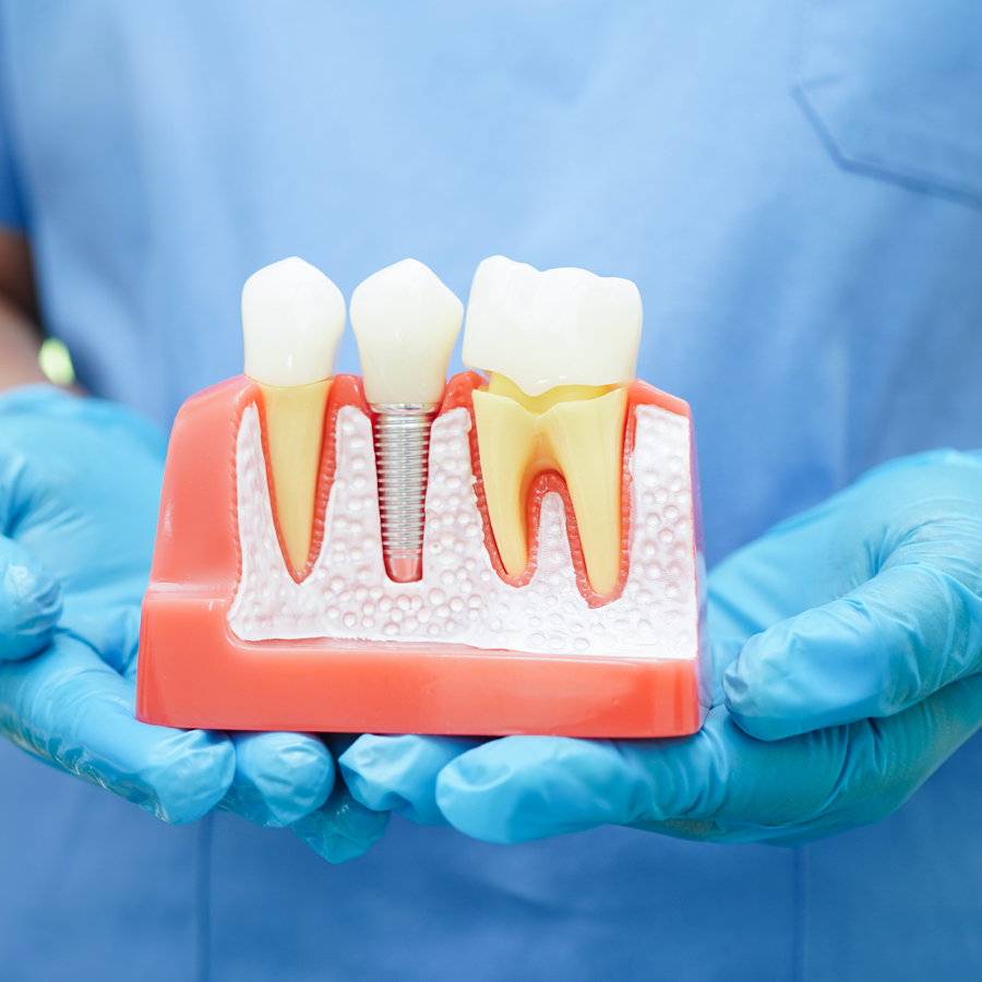 Pose d'implant | Centre dentaire de La Rive